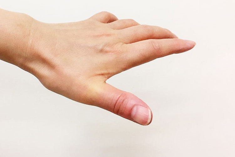 母指CM関節症イメージ