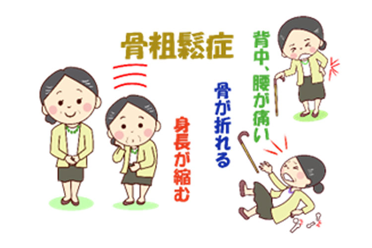 骨粗しょう症イメージ