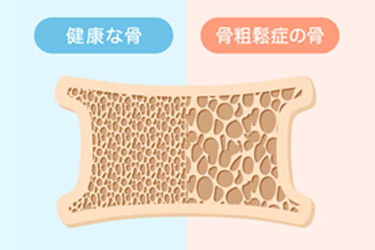 骨粗しょう症の骨密度イメージ