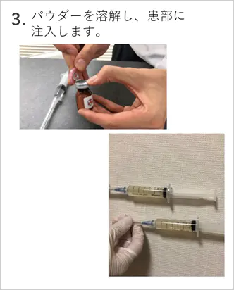PFC-FD治療：パウダーを溶解し、患部に注入します