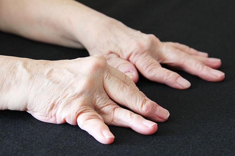 関節リウマチイメージ